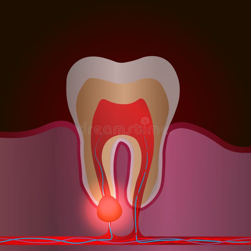 Pulpitis And Healthy Tooth Stock Vector Illustration Of Deep