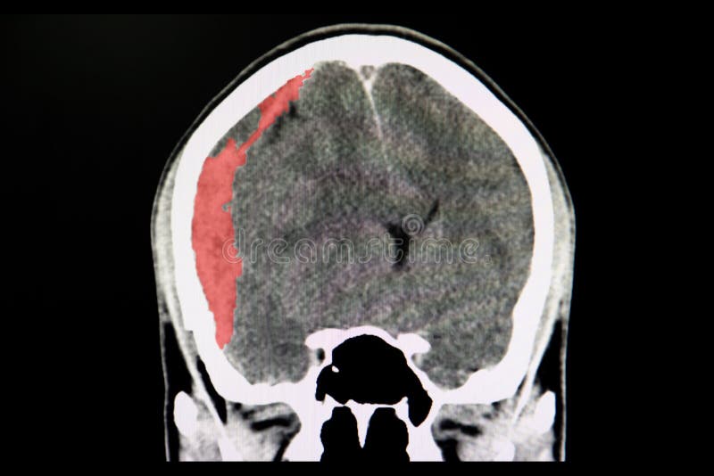 Hematoma Subdural Agudo Foto De Archivo Imagen De Agudo The Best Porn