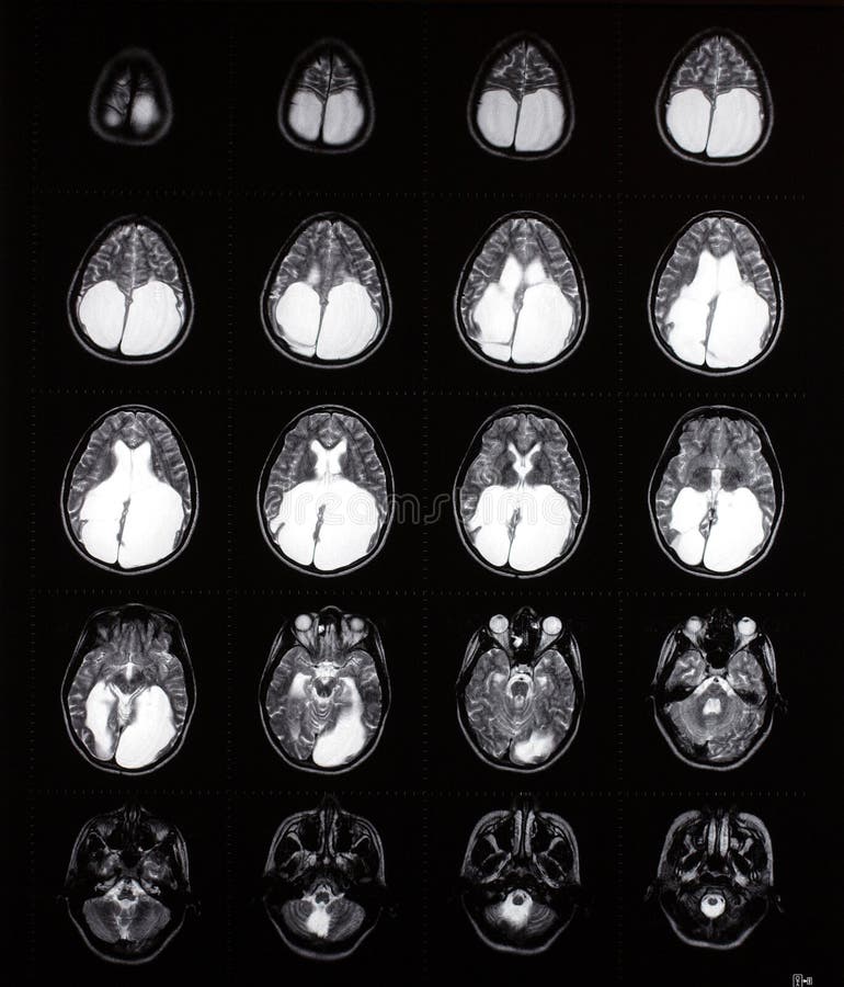 Mri Do C Rebro Que Mostra O Tumor Foto De Stock Imagem De Magn Tico