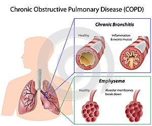 Steroids for treating copd