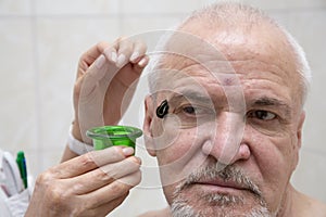 Leech therapy