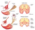 Alzheimers disease