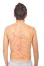 Back of man with chickenpox