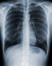 Chest X-Ray