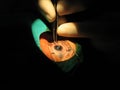 Eye Surgery