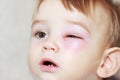 Newborn With Red Eye