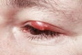 Sore Red Eye. Chalazion And Bl...