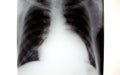 X-ray of chest, enlarged heart