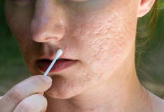 Les meilleurs moyens pour le nettoyage de la personne des points noirs