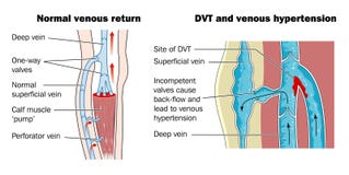 vein thrombosis antecubital veins deep fossa illustrations clipart royalty median dreamstime
