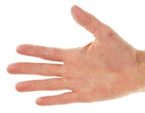 Psoriasi di medicina rossa