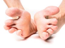 Catrame di betulla contro un fungo su unghie di gambe