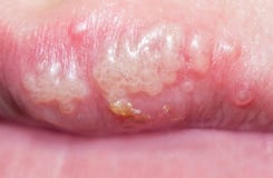 Sun and Heat Blisters on Lips: Water Blister in Mouth Home ...