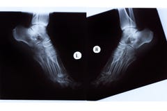 Come aiutare gambe a thrombophlebitis