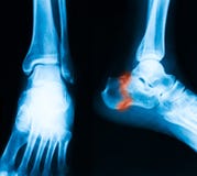 Inferior Calcaneal Spur