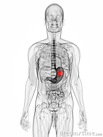 胃肿瘤 免版税库存图片 - 图片: 23934756