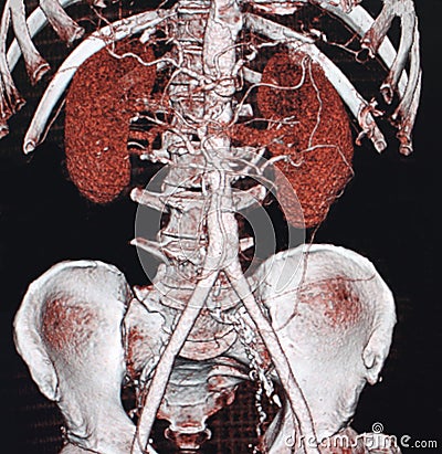 ABDOMINAL AORTIC ANEURYSM, CT