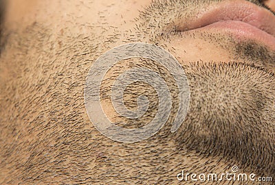 Alopecia Areata hair loss on cheek beard in a patch