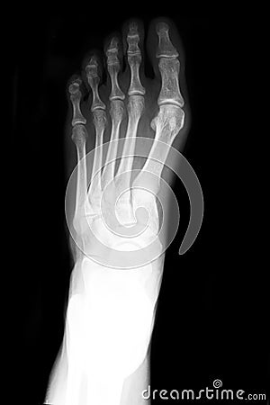 AP foot x-ray