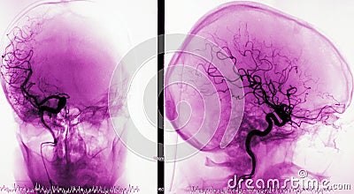 Arteriography of brain vessels