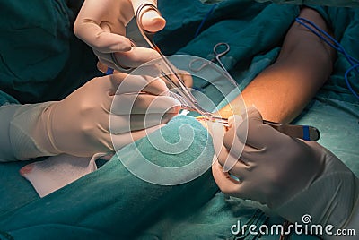 Arteriovenous fistula operation