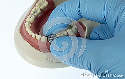 Baby tooth crown extraction