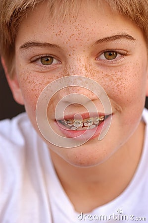 Braces With Smile
