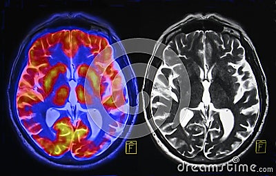 Brain scan