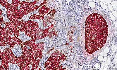 Breast cancer showing HER-2 expression