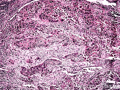 Central lung cancer of a human