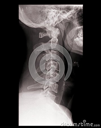Cervical spine on x-ray