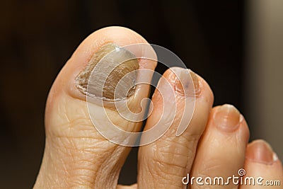 Chemotherapy Fungus Toenail