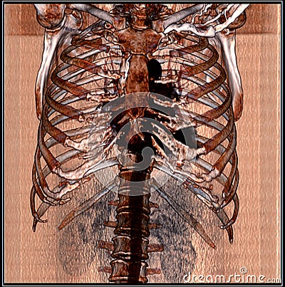 Chest CT