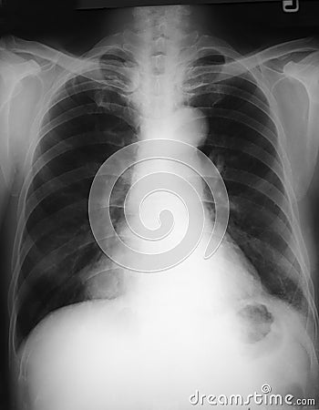 Chest film antero-posterior (AP) view of a 69 years old man, demonstrated right lower lung (RLL) mass. Final diagnosis is carcinom