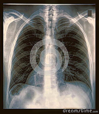 Chest X-ray Image