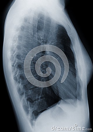 Chest X-Ray Side