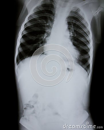 Chest x-ray of young boy