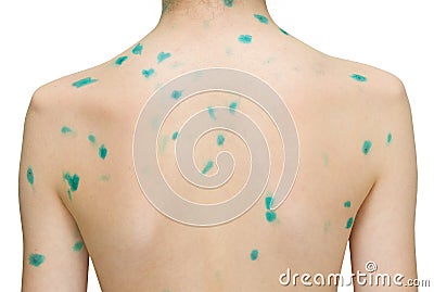itchy skin after methotrexate