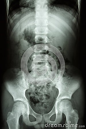 Child s spine ,abdomen ,pelvis ,hip
