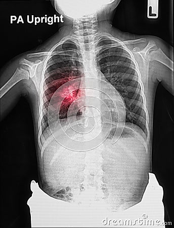 Children chest X-rays