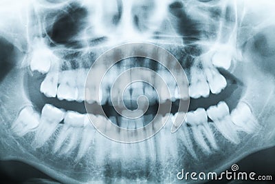 Closeup x-ray image of teeth and mouth