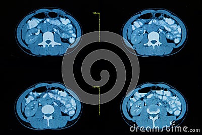 Computed tomography of the abdominal.