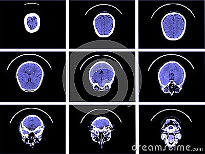 Computed tomography of brain