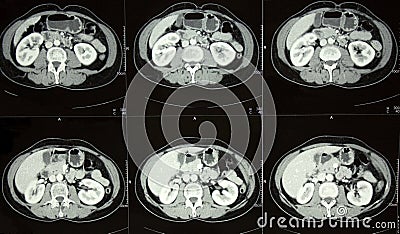 CT of Abdomen, liver, spleen, kidneys