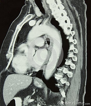CT of Chest