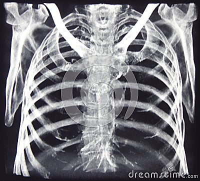 CT of chest bones