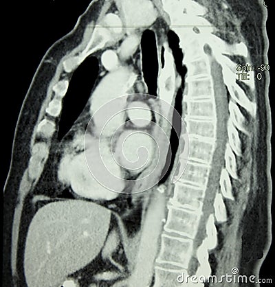 CT of Chest and Spine