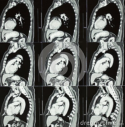 CT of Chest and Spine