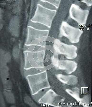 CT of Lumbar Spine
