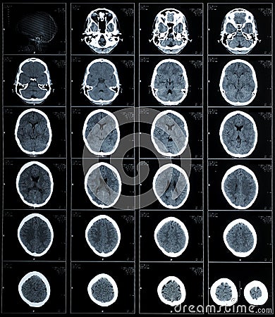 CT photography of human brain